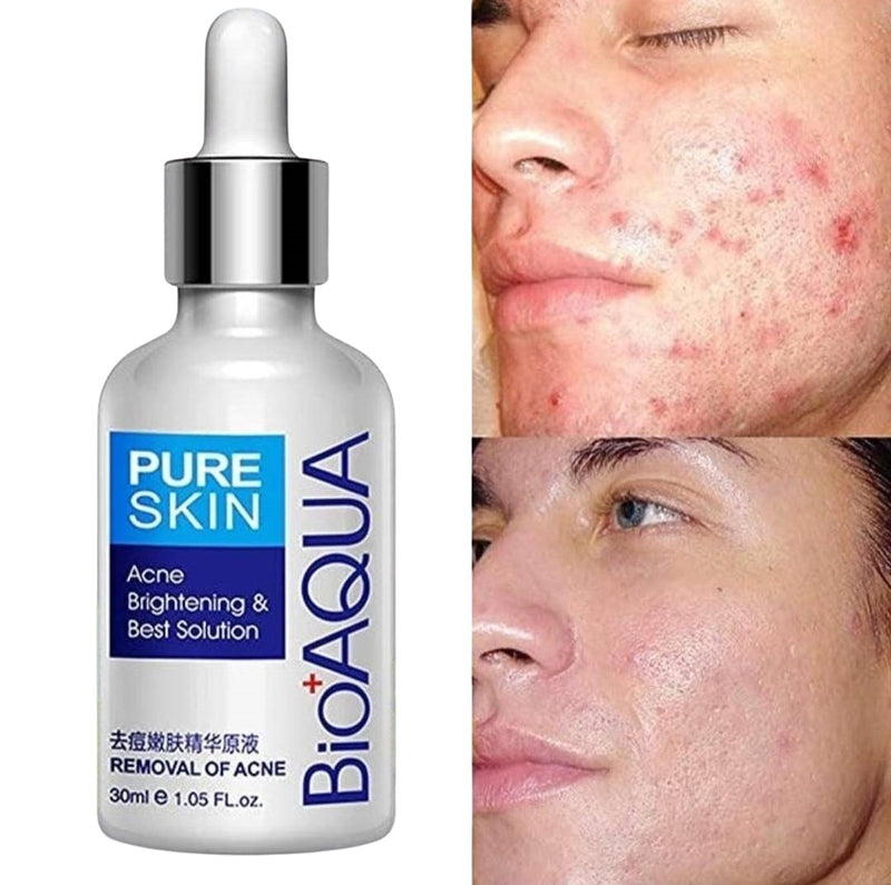 Serum Anti-Acné - Limpieza facial