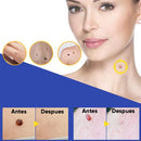 Kit Quita Verrugas + Accesorios