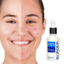 Serum Anti-Acné - Limpieza facial